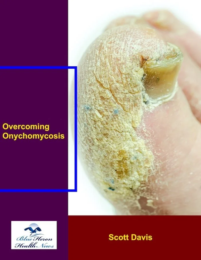 Overcoming Onychomycosis supplement bottle